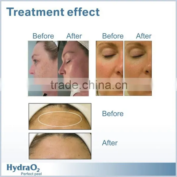 2015 New Water Dermabrasion Machine Oxygen Therapy Skin Beauty photo-4