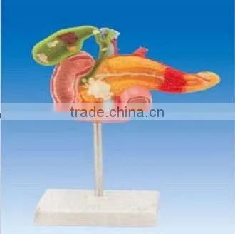 Pathological Model of Pancreas,duodenum and Gallbladder
