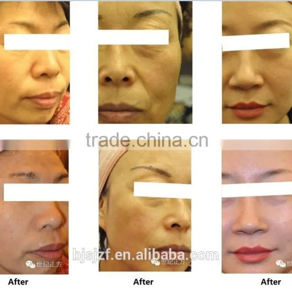 High Intensity Focused Ultrasound Face Lift With Medical CE ISO FDA photo-6