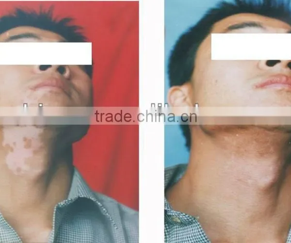 Epidermis Transplantation Vitiligo Machine photo-2