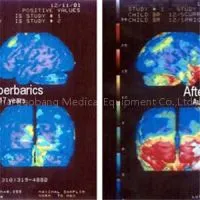 Lying Type Hyperbaric Chamber For Autism