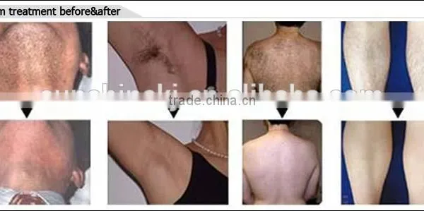 Hot Sale !!! Permanent Hair Removal Device/portable 808nm Diode Laser Device photo-6