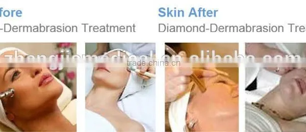 Electric Exfoliate Massager Microdermabrasion Machine,crystal Microdermabrasion Beauty Machine photo-5