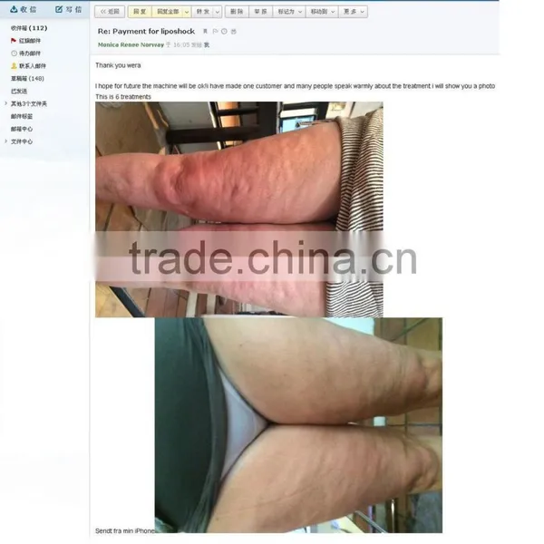 2015 Radio Frequency Rolling Guangzhou Beauty FSWT Machine Wholesaler photo-2