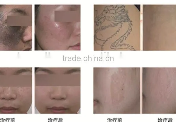 2016 Best Laser Skin Spot Remover Machine photo-3
