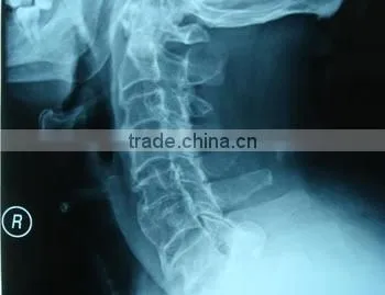 Medical X-ray Film Agfa Medical Dry Film for X-ray Machine Agfa Kodak Film photo-2