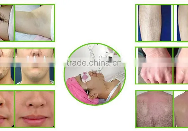 810nm Diode Laser Permanent Hair Removal Beauty Equipment photo-5