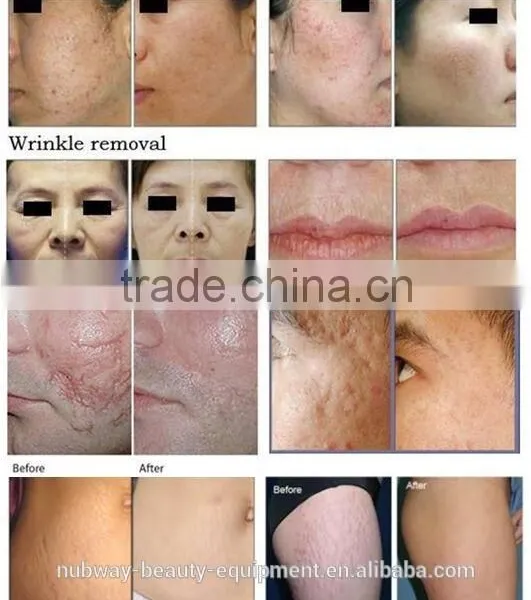 RF Pipe Fractional Co2 Carboxytherapy Laser Vaginal Tightening Machine Treat Telangiectasis photo-5