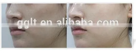 Mesogun Skin Whitening Remove Wrinkles vc Injection Machine Price photo-5