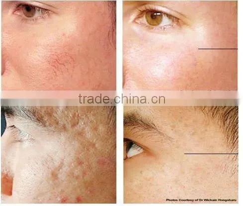 The Non-invasive Fractional rf Laser Beauty Machine for Wrinkle Removal and Face Lift photo-6