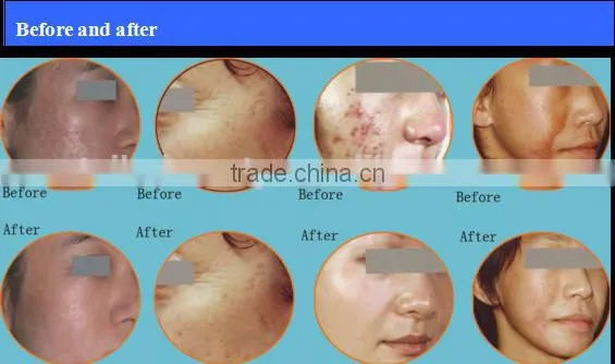 Pixel Co2 Fractional Laser photo-6
