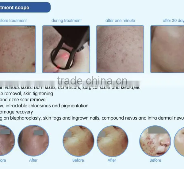 Most Advanced High Quality Beauty Equipment 10600 nm Laser Co2 Surgical Laser With USA Tube photo-5