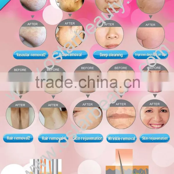 Skin Whitening Elight Handle And Bi-polar RF Handle Ipl Elight Beauty Equipment Skin Rejuvenation Skin Lifting Machine E 01 No Pain photo-6