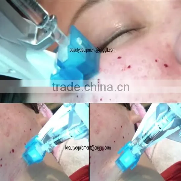 Professional Mesogun Injector for Hair Pore Shrink and Neck Wrinkle Improvement photo-6