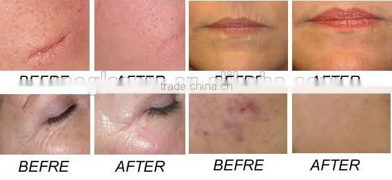 Sanhe Factory High Quality nd Yag Laser Tattoo Removal Beauty Equipment for Pigment Removal and Tattoo Removal photo-6