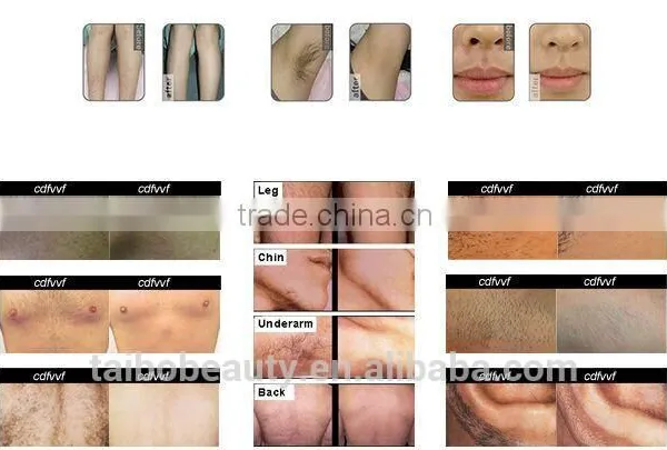 2016 Trending Products 808nm Diode Laser Hair Removal Beauty Cosmetics Kemei Hair Remover photo-6