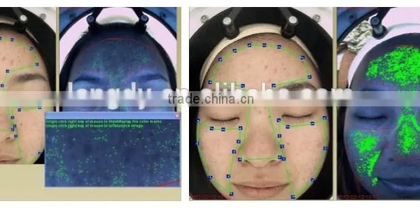 Computer Software Skin Analysis System Acne Wrinkle Spot Pore Analyzer Device photo-5