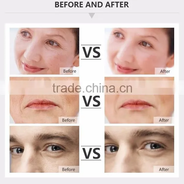 Personalcare Skin Lightening Radio Frequency Machine photo-4