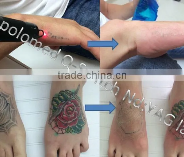 Tattoo Removal System nd Yag Laser photo-5