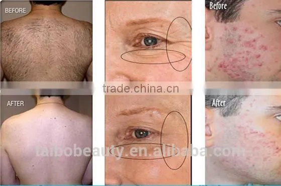 Pain-Free Professional Dual System Permanent Hair Removal/ipl Bode Shr Skin Rejuvenation Tightening Wrinkle Removal/SHR Diode Laser photo-6