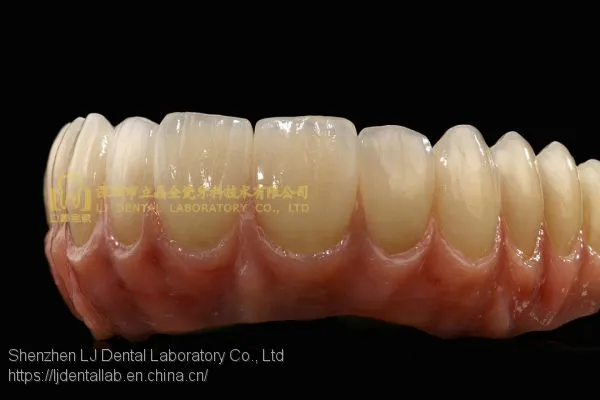 Dental Implant Prosthesis, Implant Denture, Dental Prosthesis, Laboratoire Dentaire, Dentallabor, Laboratorio Dental, Dental Laboratory, Shenzhen LJ Dental Lab China photo-5