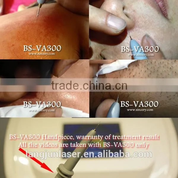 Upgrade Technique Best HF Facial Red Vessel Treatment photo-4