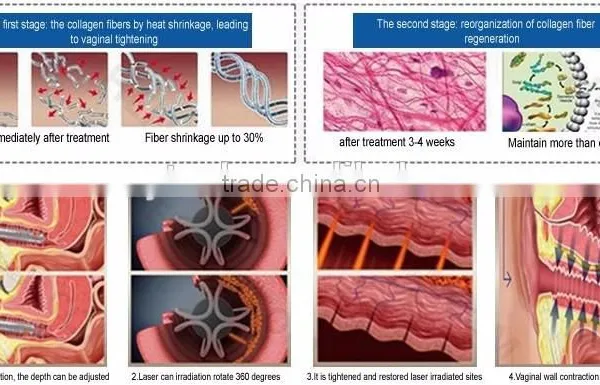 Professional Fractional Co2 Laser Vagina Co2 Fractional Laser VH613 photo-5