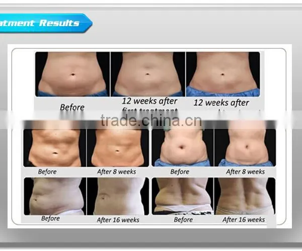 Hot Sell Freeze Fat Slimming Machine Cool Sculpting Cryolipolysis Machine Crypolysis Fat Freezing Machine 500W photo-4