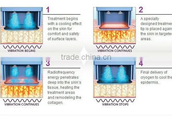 TRF-01 Non Invasive RF Machine Skin Tightening Device for Home Use photo-3
