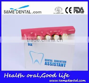 2x Periodontal Disease Classification Models Dental Eduction Assitant No. DEA-20 photo-4