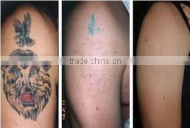 ND Yag Laser Tattoo Removal Machine With Laser Removal Tattoo Machine Q-switch Fuction/Q-switch ND Yag Naevus Of Ota Removal photo-6