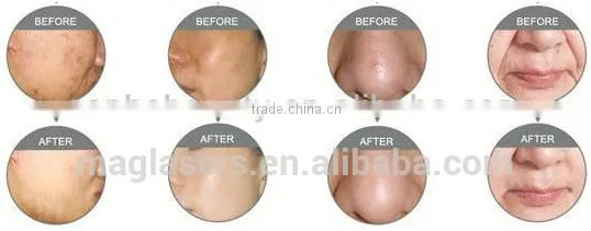 Facial Veins Treatment Professional Manufacture Sanhe 1000W Beauty Machine Nd Yag Laser Machine photo-6