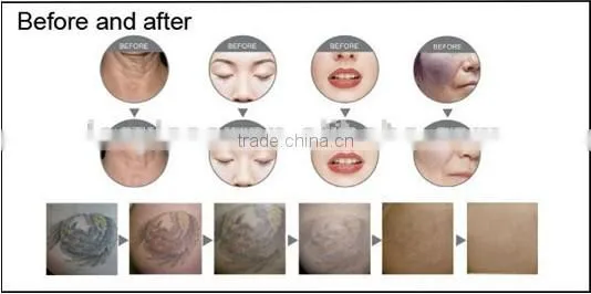 nd Yag Laser With Black Tip for Skin Whitening Laser Carbon Treatment photo-4