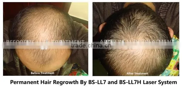 Professional Low Level Laser Therapy Hair Loss Treatment Hair Growth Machine To Men And Women photo-5