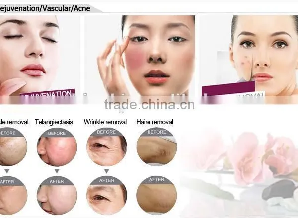 Best Facial Removal Salom Beauty Machine With Beauty Energy Bar photo-6