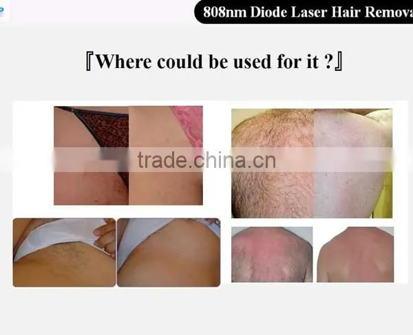808nm Diode Laser Hair Removal Machine POP-DLP8 photo-2