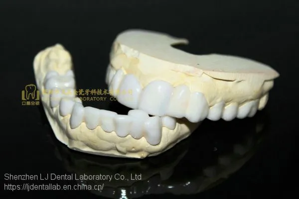 Dental PETG Clip on Veneers, Snap-on-veneers, Smile Veneers, Laboratoire Dentaire, Dentallabor, Laboratorio Dental, Dental Laboratory, Shenzhen LJ Dental Lab China photo-4