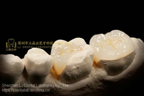 Dental Crown E.Max Ceramic, Porcelain Crown, Dental Veneers, Laboratoire Dentaire, Dentallabor, Laboratorio Dental, Dental Laboratory, Shenzhen LJ Dental Lab China