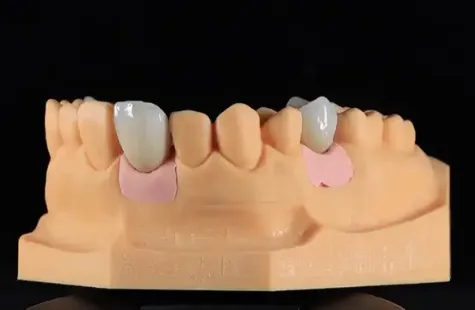 Dental Telescope Denture, Telesope Crown, Dental Prothesis, Laboratoire Dentaire, Dentallabor,Dental photo-2