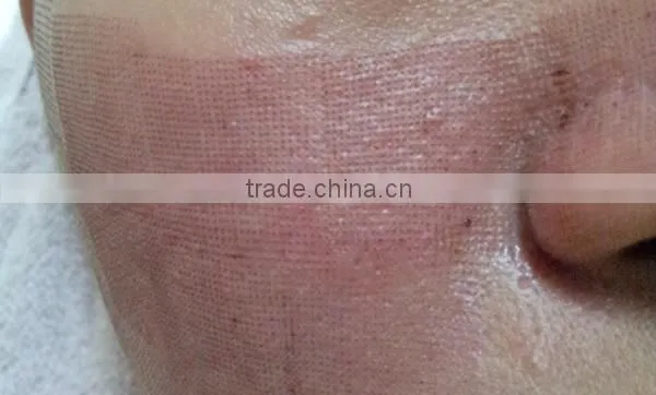 ER Yag Laser Acne Treatment Scar Removal Machine Erbium Laser Remove Chloasma CO2 Laser photo-6