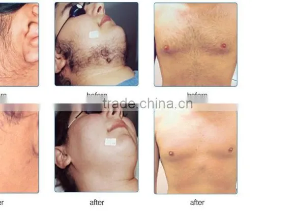 Portable Ipl Elight Hair Removal Skin Rejuvenation Beauty Machine photo-4