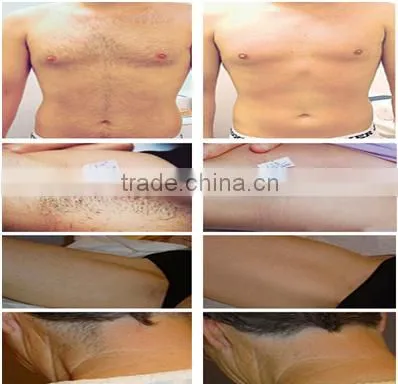 Beijing Sincoheren SMQ-NK IPL Hair Removal & Skin Rejuvenation Equipment photo-3