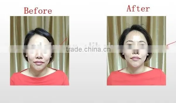 Small Machines to Make Money Face Lifting Machines Thermal rf Beauty Equipment photo-3