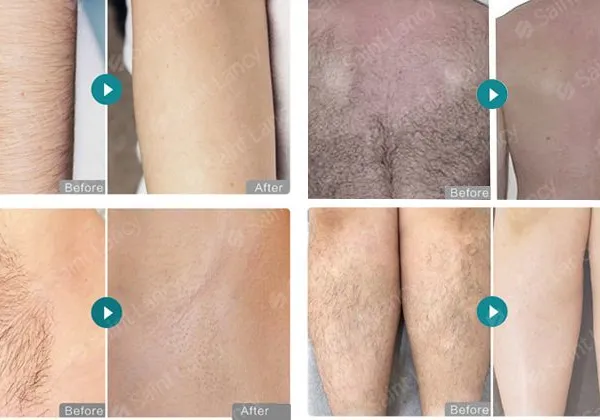 Triple Wavelength 808nm 755nm 1064nm Diode Laser Hair Removal Machine 10Hz Repetition Rate 3-Handle photo-3
