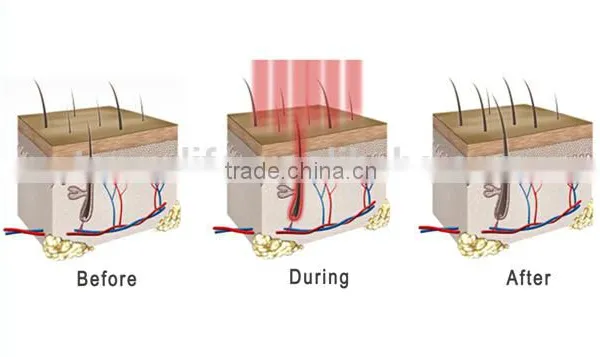 NL-SF650 LOW Price ! Laser Hair Comb Personalized Hair Comb , Laser Hair Regrowth Comb photo-6
