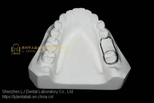 Space Expanders, Nance Appliance, Helix Appliance, Pendulum Appliance, ﻿﻿﻿﻿Porter Appliance, Fixed Lingual Expander, Sagittal Screw Appliance, Hyrax Rapid Palatal Expander, Orthodontic Retainers, Dental Orthodontic Appliance, Laboratoire Dentaire, Dentall photo-2