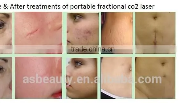 Speckle Removal Skin Regeneration Portable 10600nm CO2 Fractional Age Spot Removal Laser Equipment For Scar Removal/handheld Co2 Laser 40w photo-6