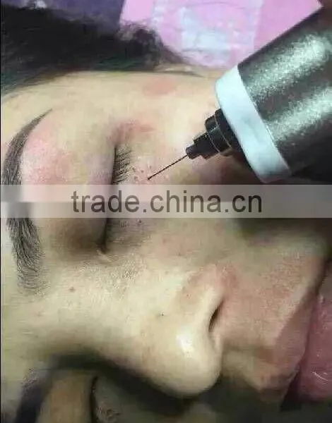 High Frequency Spot Removal Pen Speckle Removal photo-3