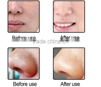 Black Head Remover Machine photo-4