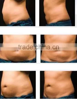 2016 Newest !!Fast Cellulite Reduction Machine / / Freezing Fat Cell Slimming Machine photo-6